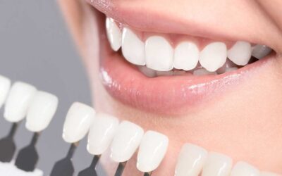 Teeth whitening