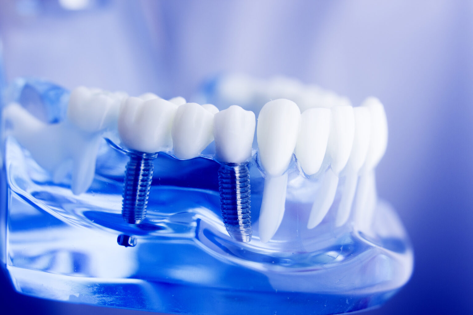 Dental Implants In SE Calgary Dental Implants Near You   Dental Implants In Se Calgary 