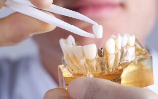 The Pros And Cons Of Dental Implants 320x202