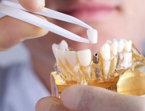 The Pros and Cons of Dental Implants