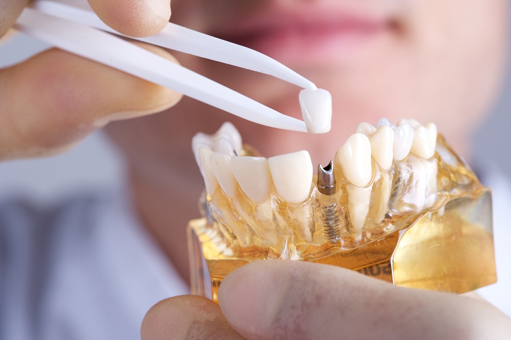 The Pros And Cons Of Dental Implants
