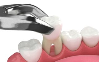 recovery tips and aftercare following tooth extraction