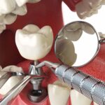 What is the Best Age to Get Dental Implants?