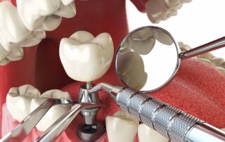 What is the Best Age to Get Dental Implants?